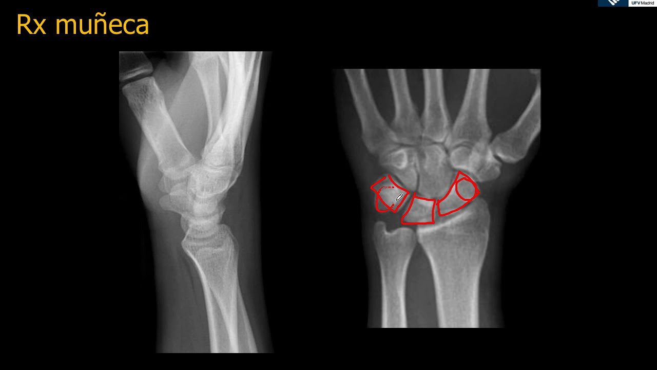 Qué Es Una Radiografía De Muñeca En Proyección AP Y Oblicua