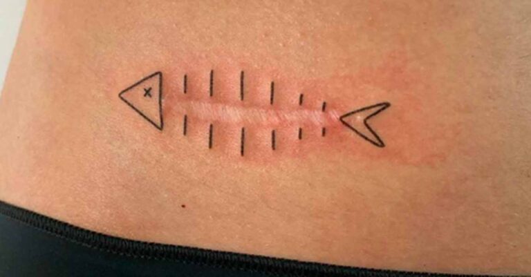 Es seguro hacerse un tatuaje encima de una cicatriz
